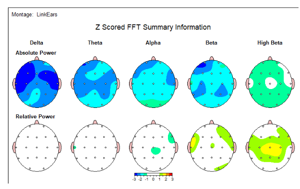 Brain scans of concussions